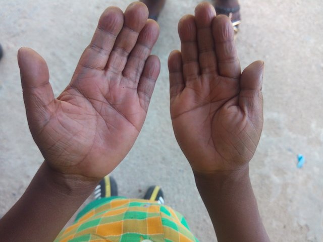 Toby's palms turning blue as his condition worsens by the day